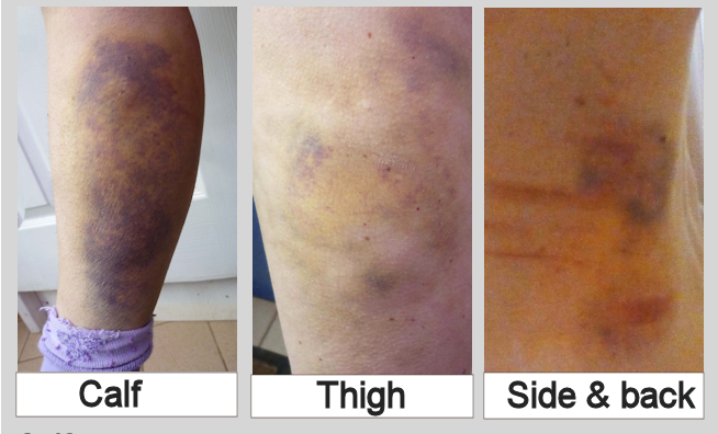 Severe bruising after cow attack and trampling