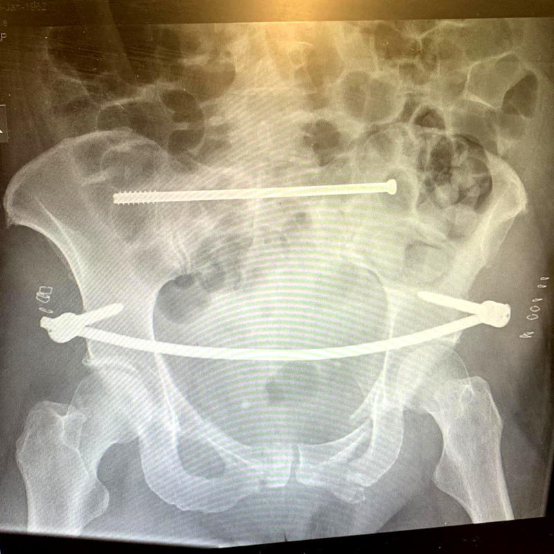 RR’s story: fractured ribs and shattered&nbsp;pelvis.
